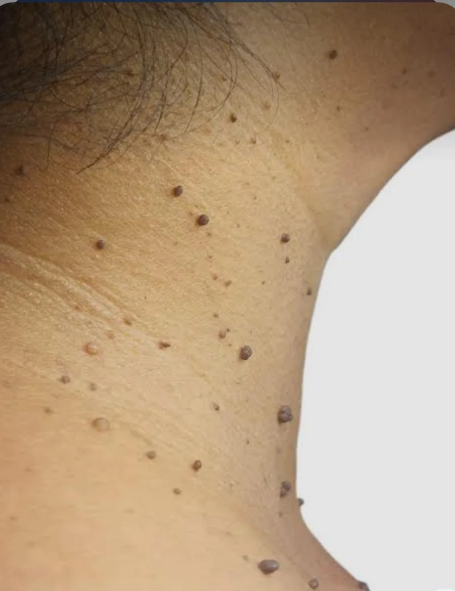 Skin tag removal treatment at Patricia Beauty Clinic Kimberley